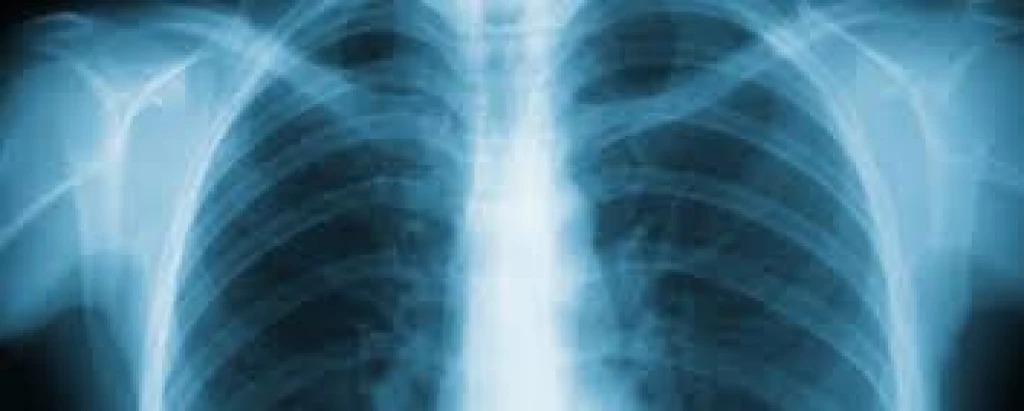 Nueva terapia da esperanza a pacientes con fibrosis pulmonar en México