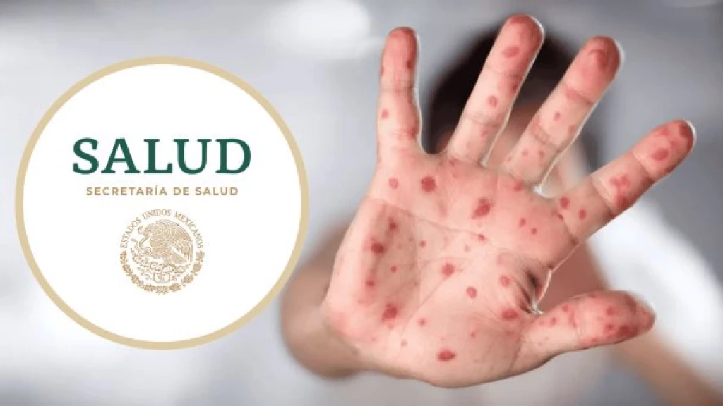 Ciudad de México encabeza la lista con más casos de mpox