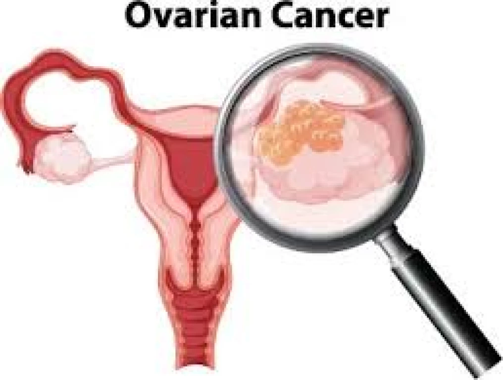 Cáncer de Ovario la primera causa de muerte ginecológica en mujeres
