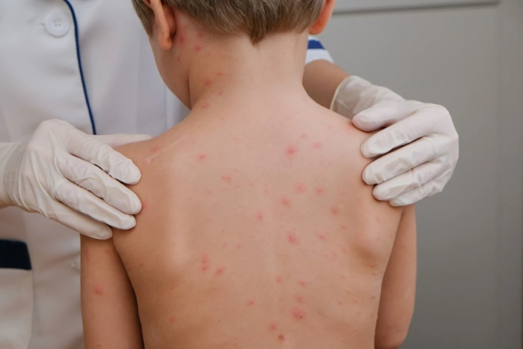Acuda al médico ante síntomas de sarampión
