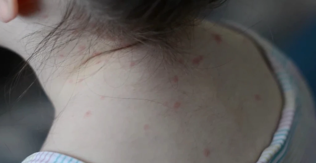 Ahome permanece libre de casos de virus Coxsackie: Salud Municipal