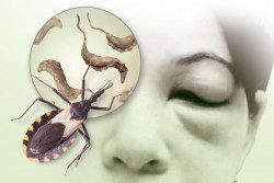 Alertan sobre el bajo diagnóstico de la enfermedad de Chagas en EE.UU.