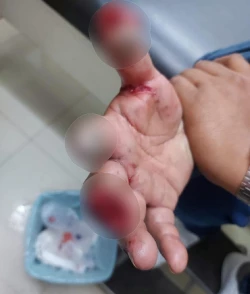 Joven pierde dedo tras tronarle un cuete en la mano en la comunidad de El Zapote, Mazatlán