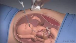 En Sinaloa ya se realizan con éxito cirugías fetal
