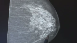23 mil 790 casos de cáncer de mama en México
