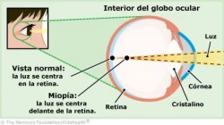 La miopía está en aumento