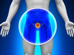 En Sinaloa se registraron más de 220 defunciones por cáncer de próstata