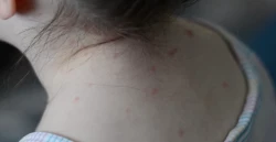 Ahome permanece libre de casos de virus Coxsackie: Salud Municipal